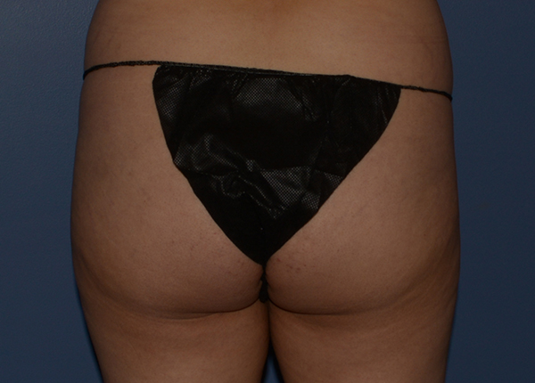 Brazilian Butt Lift