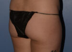 Brazilian Butt Lift