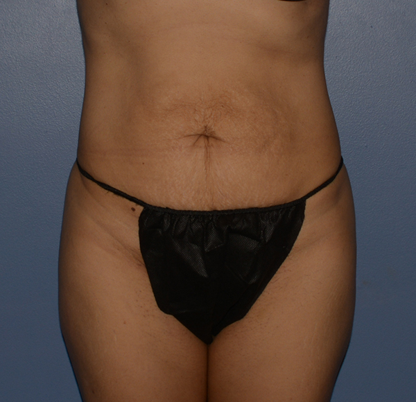 Tummy Tuck