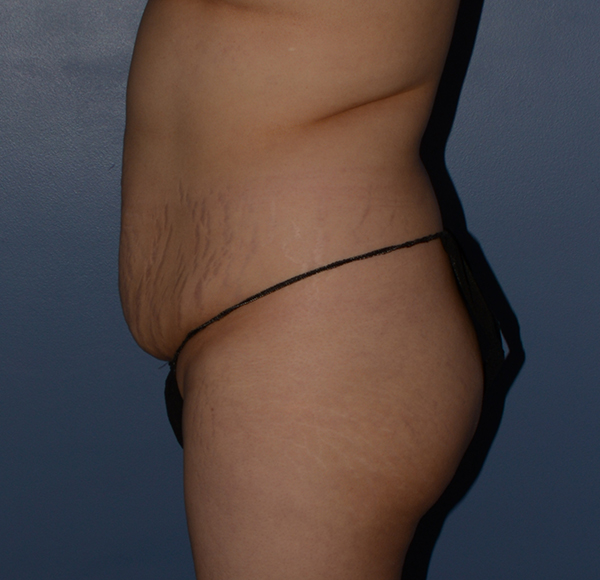 Tummy Tuck