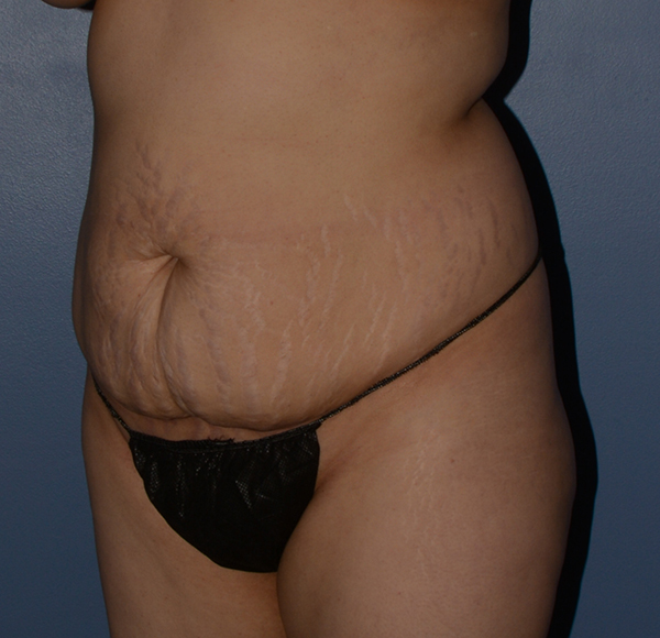 Tummy Tuck
