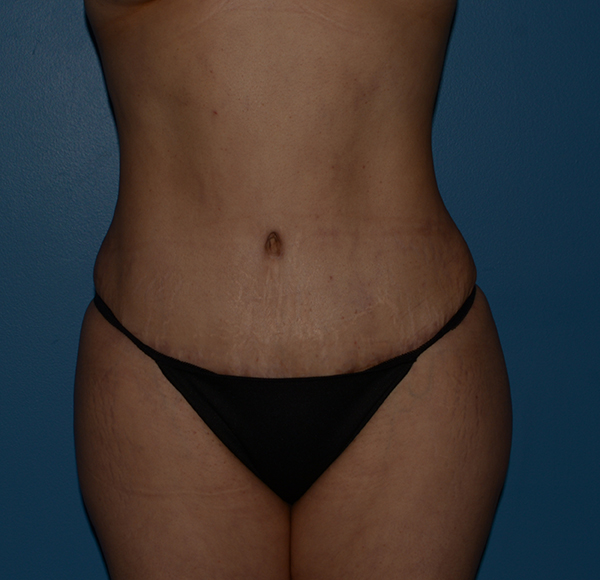 Tummy Tuck