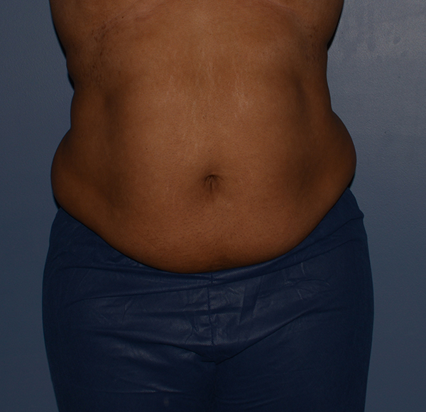 Tummy Tuck