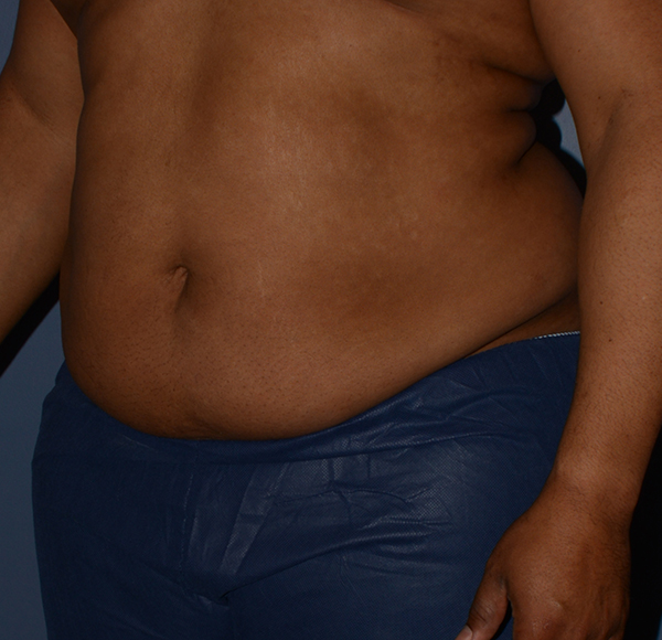 Tummy Tuck