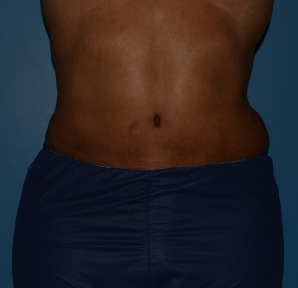 Tummy Tuck