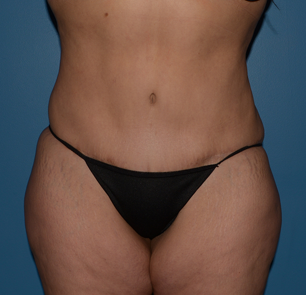 Tummy Tuck