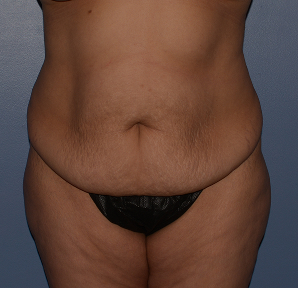 Tummy Tuck