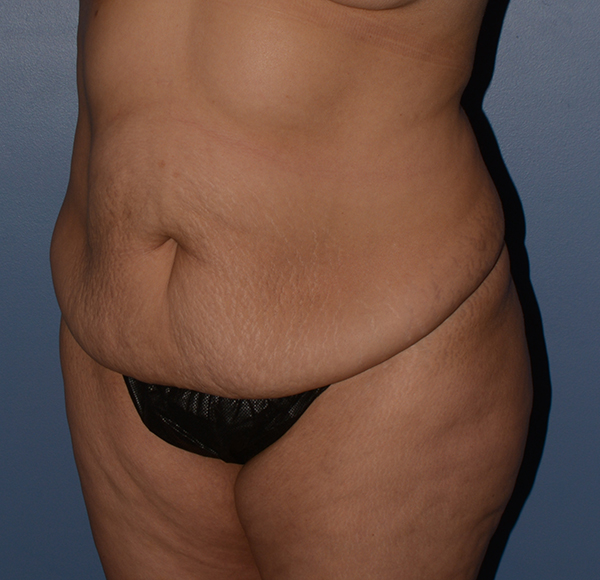Tummy Tuck