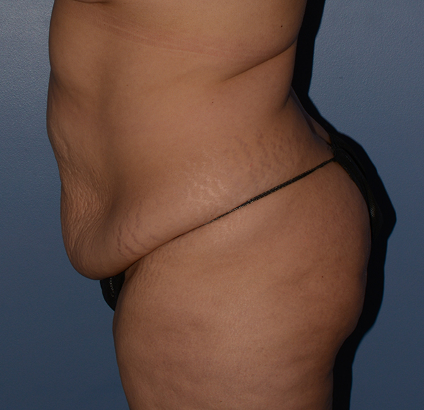 Tummy Tuck