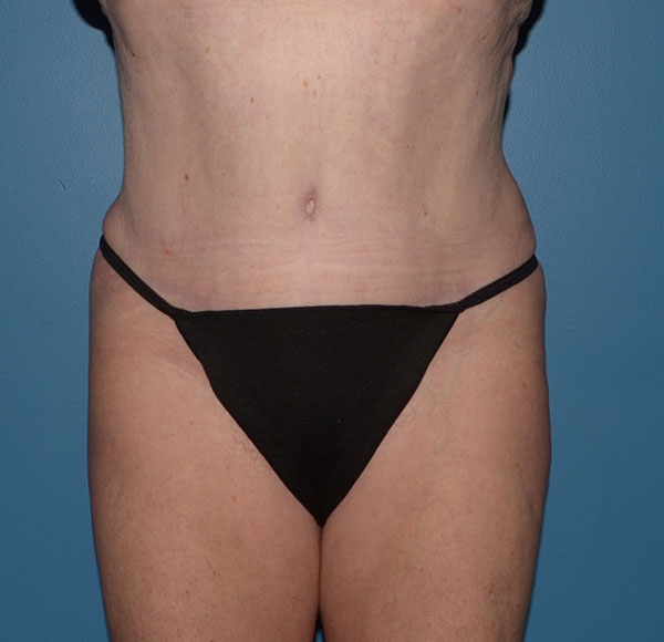 Tummy Tuck