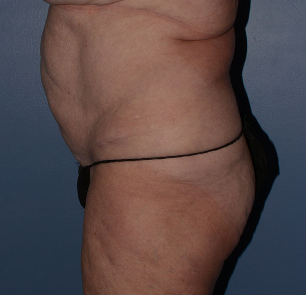 Tummy Tuck