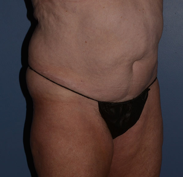 Tummy Tuck