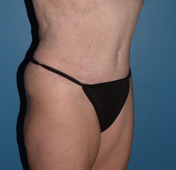 Tummy Tuck