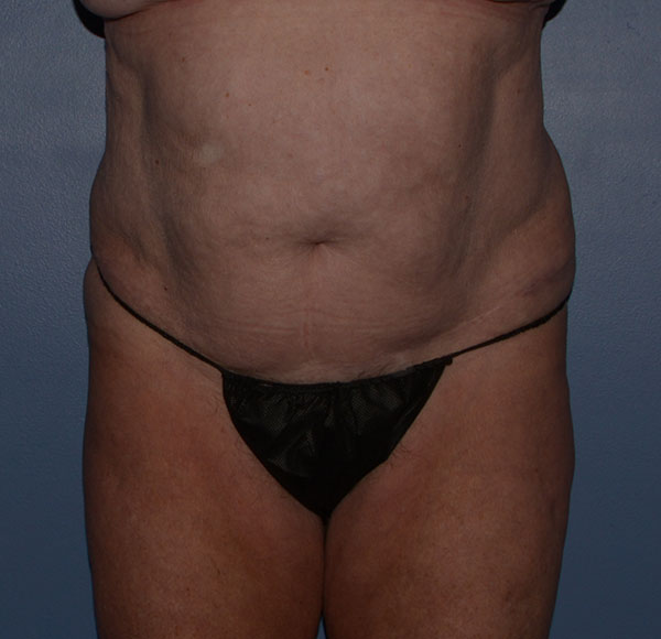 Tummy Tuck