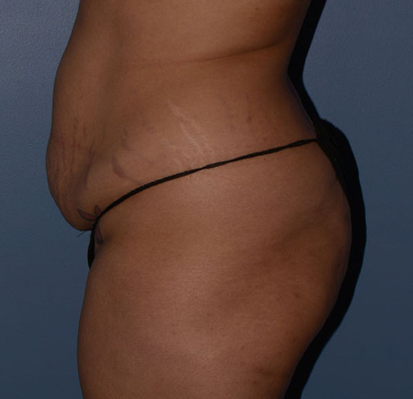 Tummy Tuck