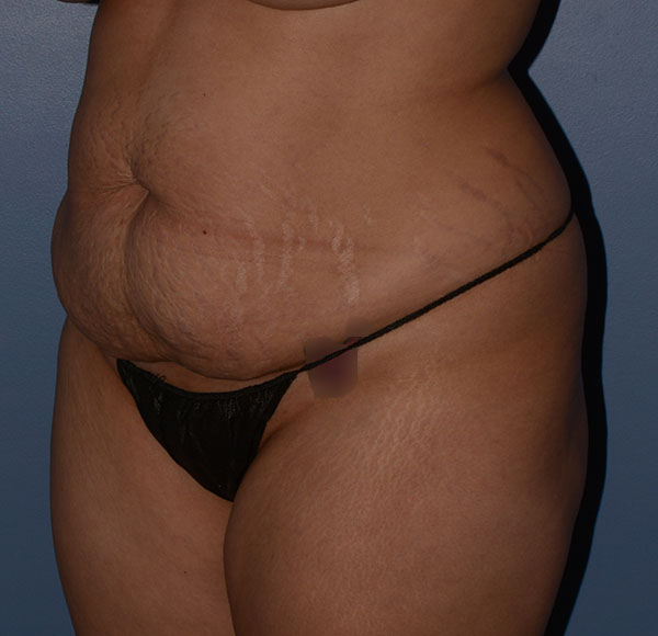 Tummy Tuck