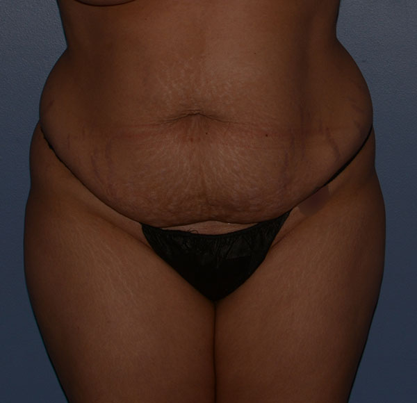 Tummy Tuck