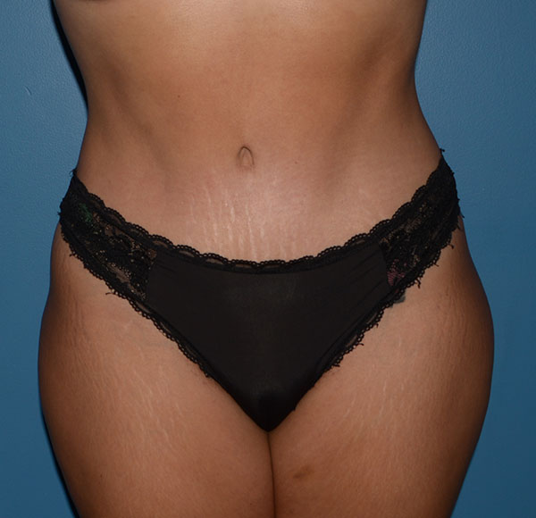 Tummy Tuck