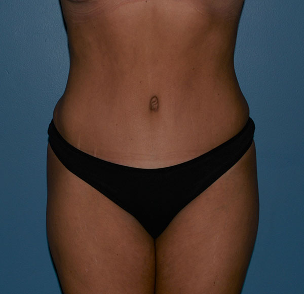Tummy Tuck