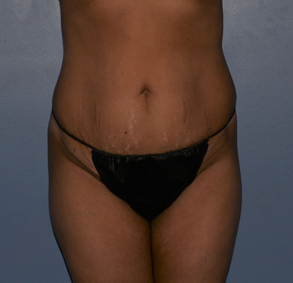 Tummy Tuck