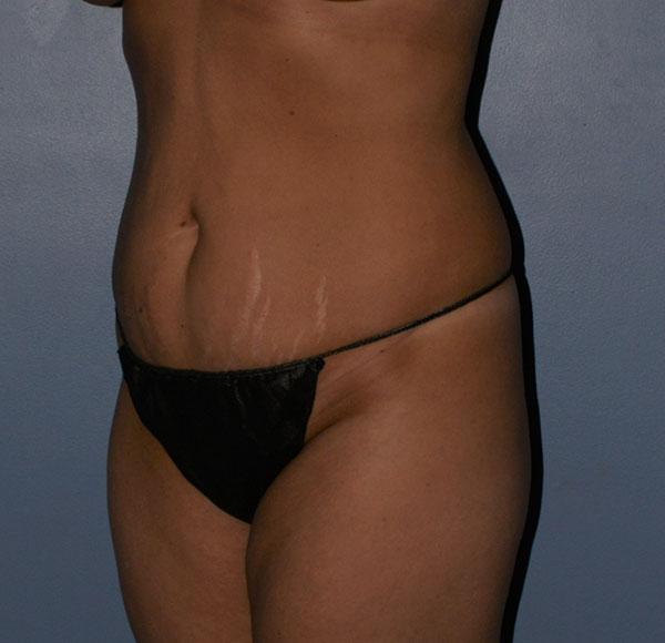 Tummy Tuck
