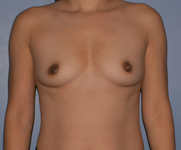 Breast Augmentation Implants