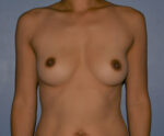 Breast Augmentation Implants