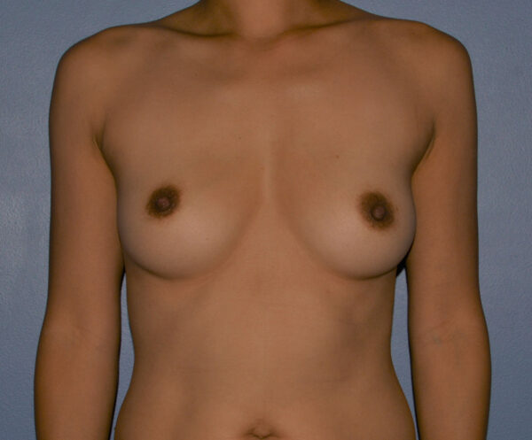 Breast Augmentation Implants