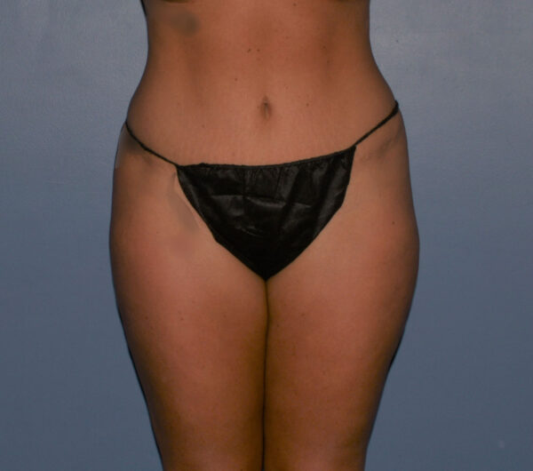 Liposuction