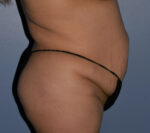 Tummy Tuck