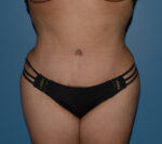 Tummy Tuck