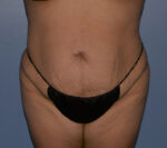 Tummy Tuck