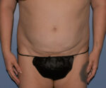 Tummy Tuck