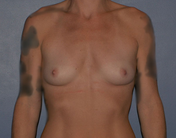 Breast Augmentation Implants