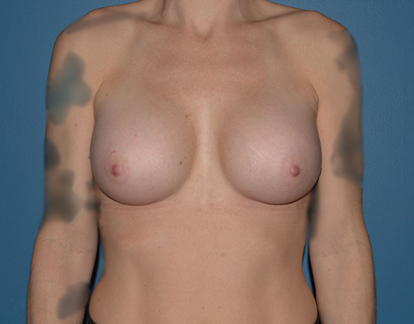 Breast Augmentation Implants