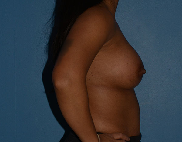 Breast Augmentation Implants