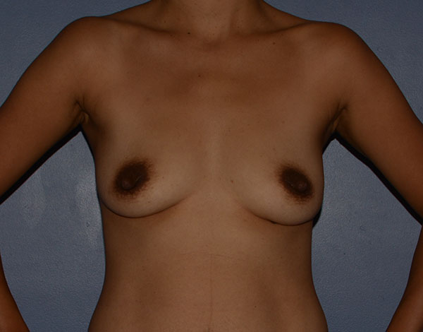 Breast Augmentation Implants