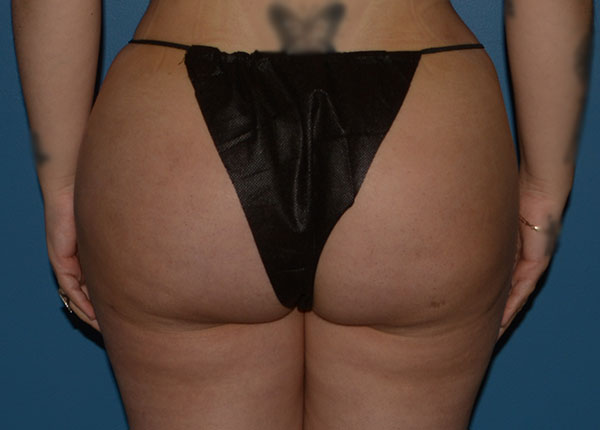 Brazilian Butt Lift