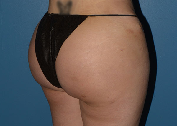 Brazilian Butt Lift
