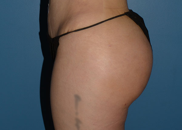 Brazilian Butt Lift