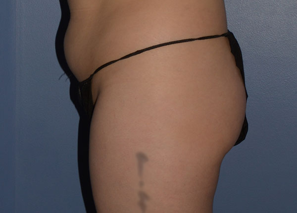 Brazilian Butt Lift