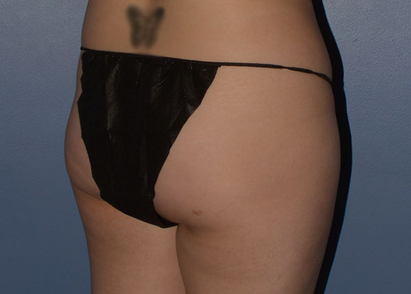 Brazilian Butt Lift