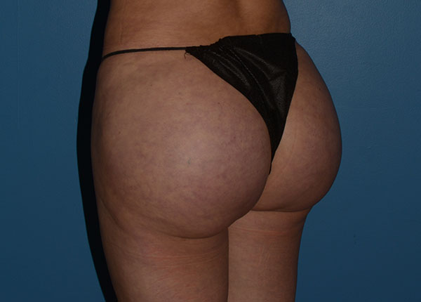 Brazilian Butt Lift