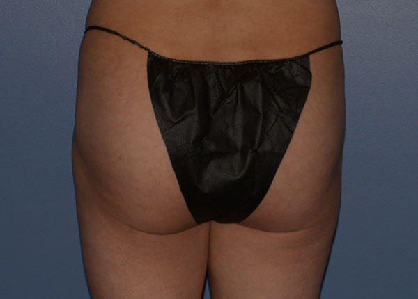 Brazilian Butt Lift