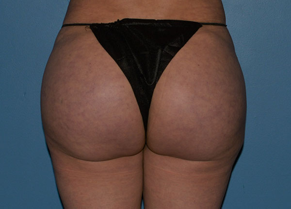 Brazilian Butt Lift