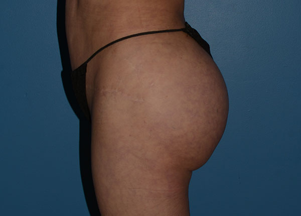 Brazilian Butt Lift