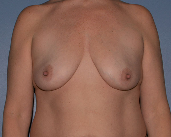 Breast Lift