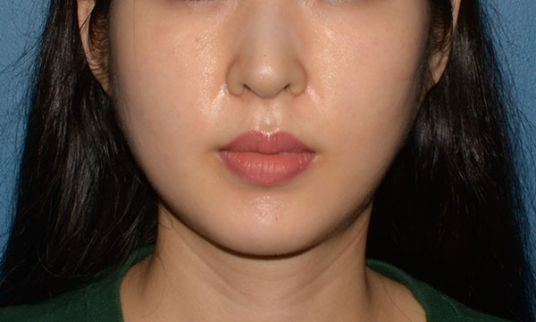 Buccal Fat Removal