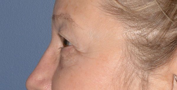 Eyelid Lift