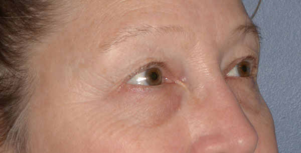 Eyelid Lift